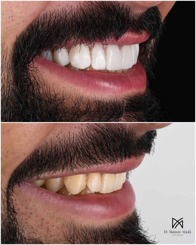 نمونه درمان لمینیت سرامیکی در اصفهان دکتر منصوره سادات ابطحی