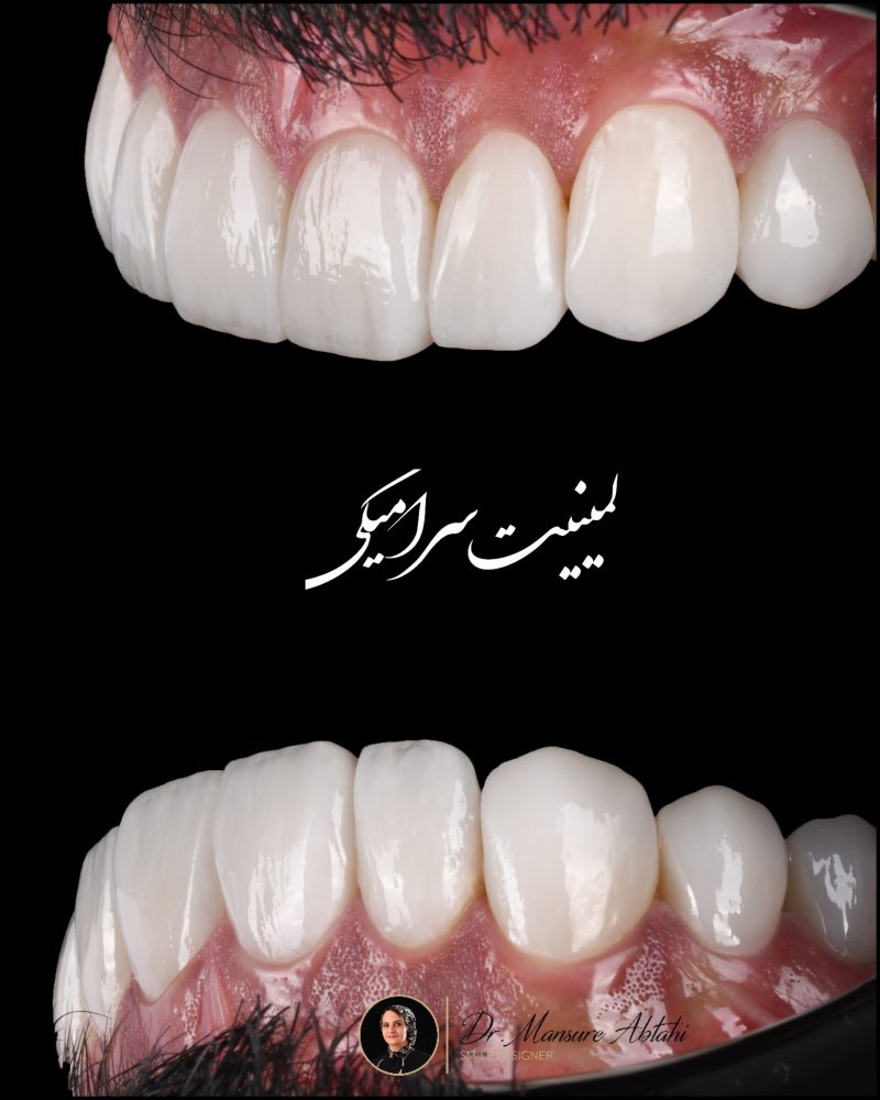 نمونه درمان لمینیت سرامیکی در اصفهان دکتر منصوره سادات ابطحی