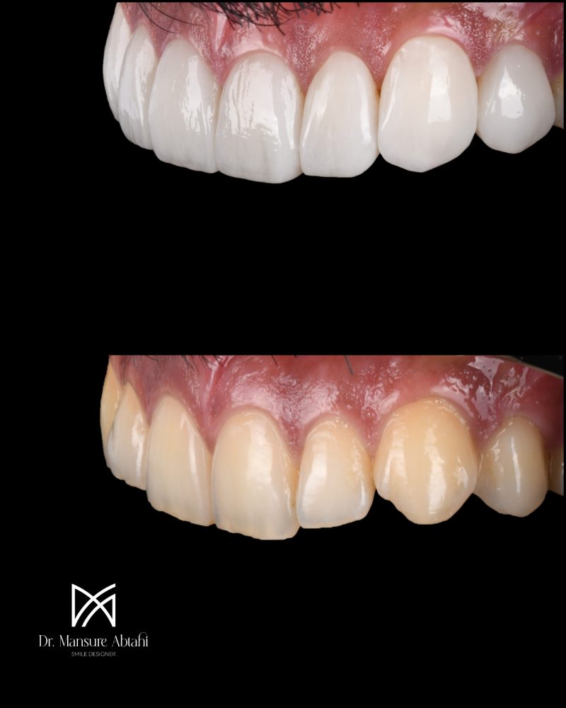 نمونه درمان لمینیت سرامیکی در اصفهان دکتر منصوره سادات ابطحی