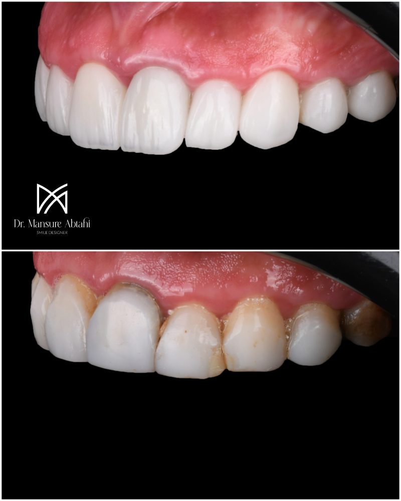 نمونه درمان لمینیت سرامیکی در اصفهان دکتر منصوره سادات ابطحی