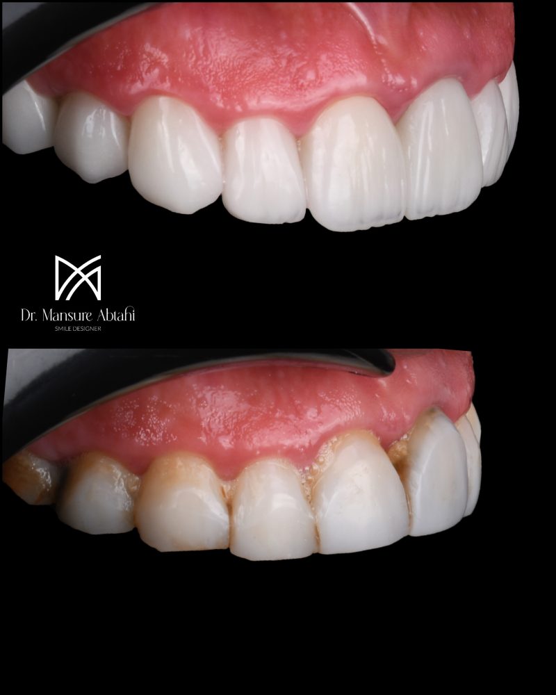 نمونه درمان لمینیت سرامیکی در اصفهان دکتر منصوره سادات ابطحی