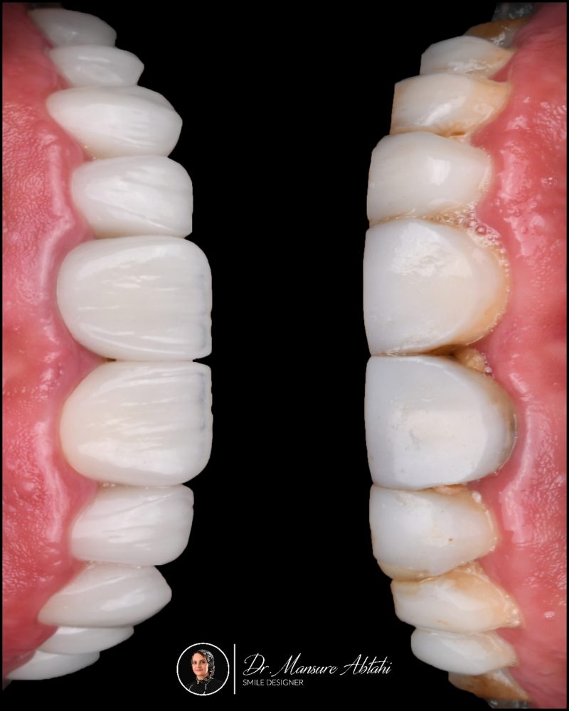 نمونه درمان لمینیت سرامیکی در اصفهان دکتر منصوره سادات ابطحی