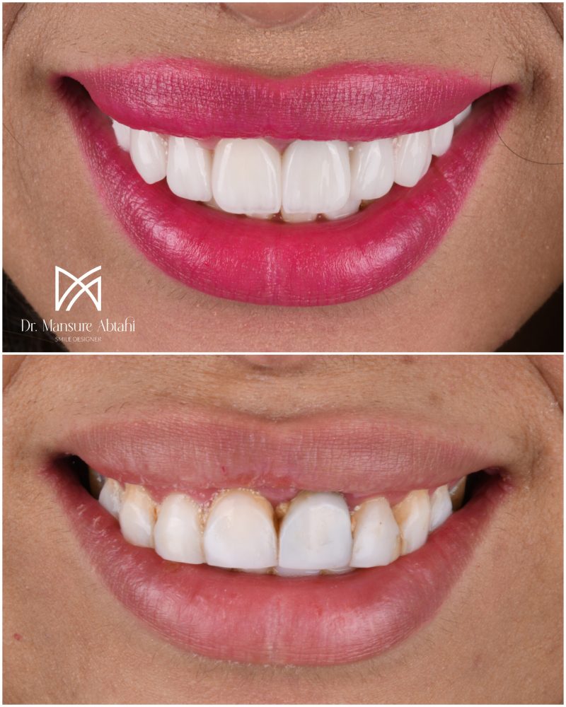 نمونه درمان لمینیت سرامیکی در اصفهان دکتر منصوره سادات ابطحی