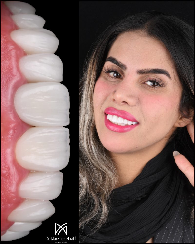 نمونه درمان لمینیت سرامیکی در اصفهان دکتر منصوره سادات ابطحی