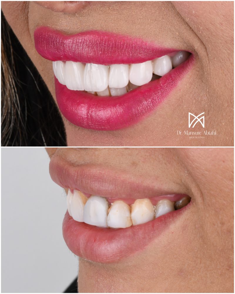 نمونه درمان لمینیت سرامیکی در اصفهان دکتر منصوره سادات ابطحی