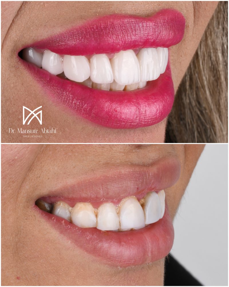 نمونه درمان لمینیت سرامیکی در اصفهان دکتر منصوره سادات ابطحی