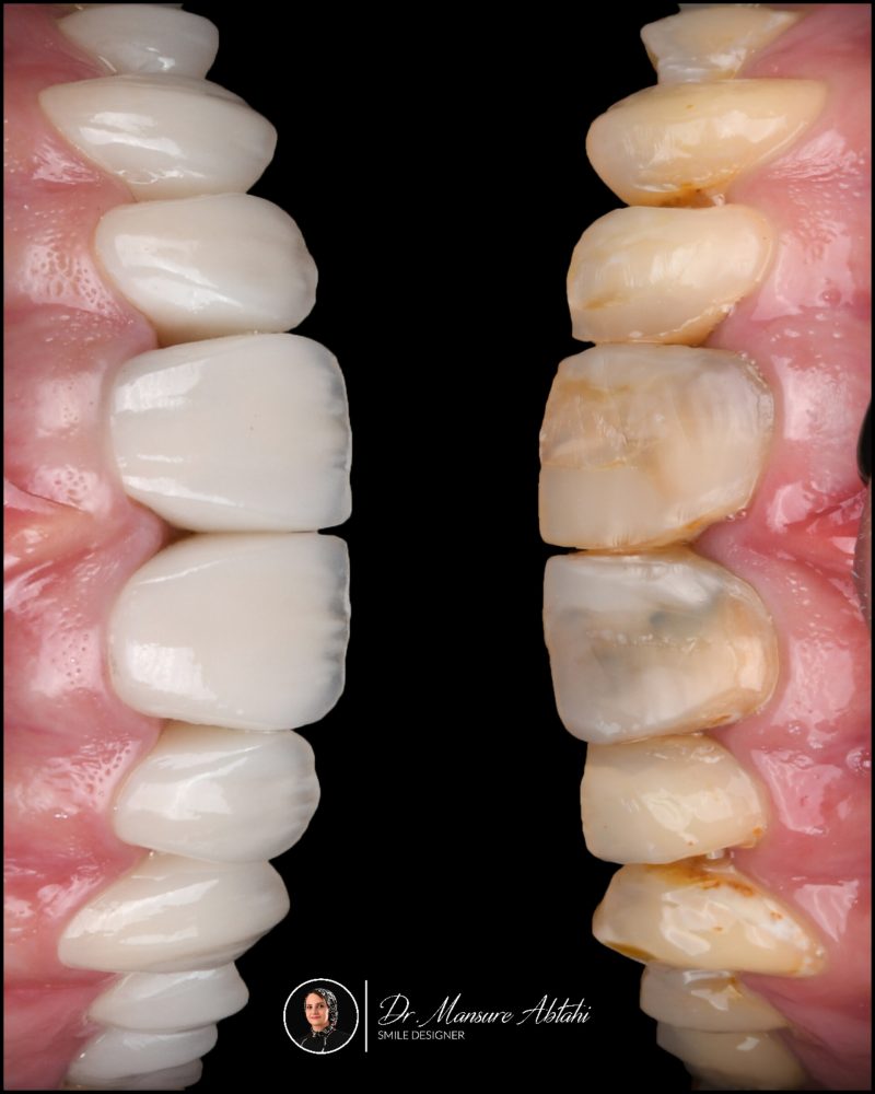 نمونه درمان لمینیت سرامیکی در اصفهان دکتر منصوره سادات ابطحی