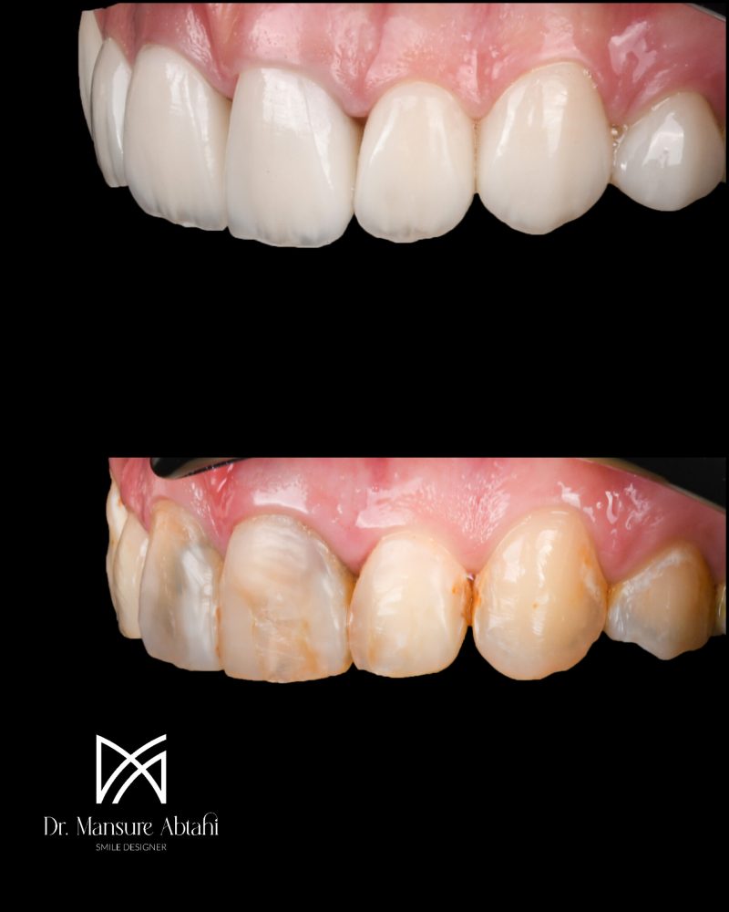 نمونه درمان لمینیت سرامیکی در اصفهان دکتر منصوره سادات ابطحی