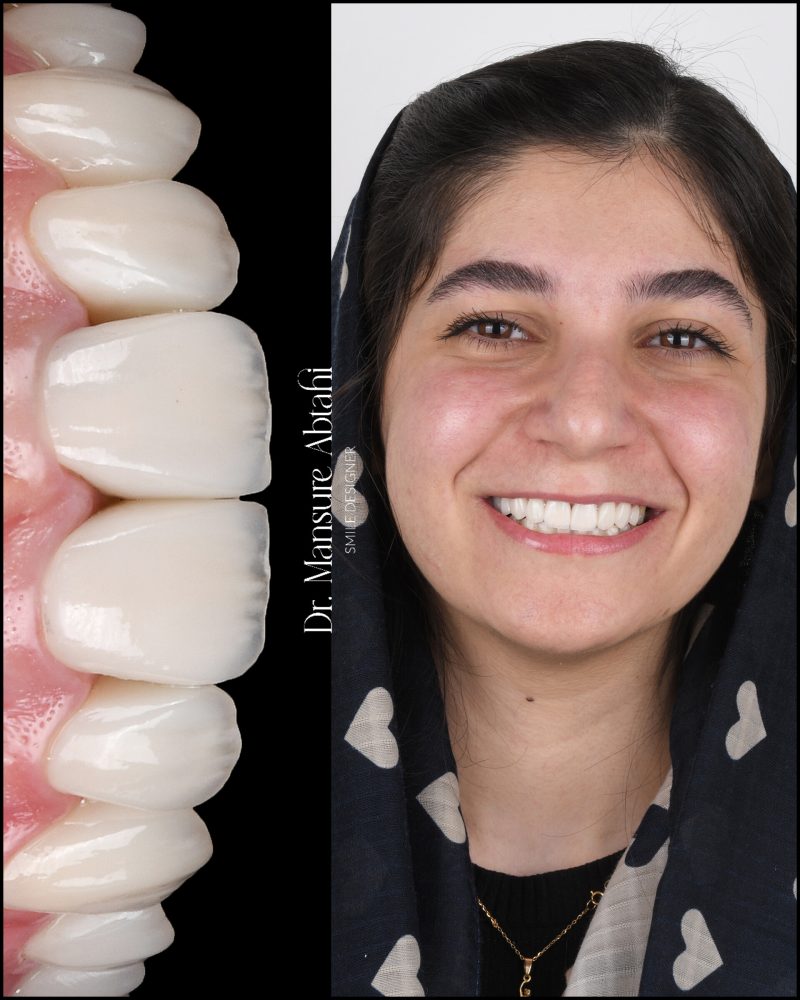 نمونه درمان لمینیت سرامیکی در اصفهان دکتر منصوره سادات ابطحی