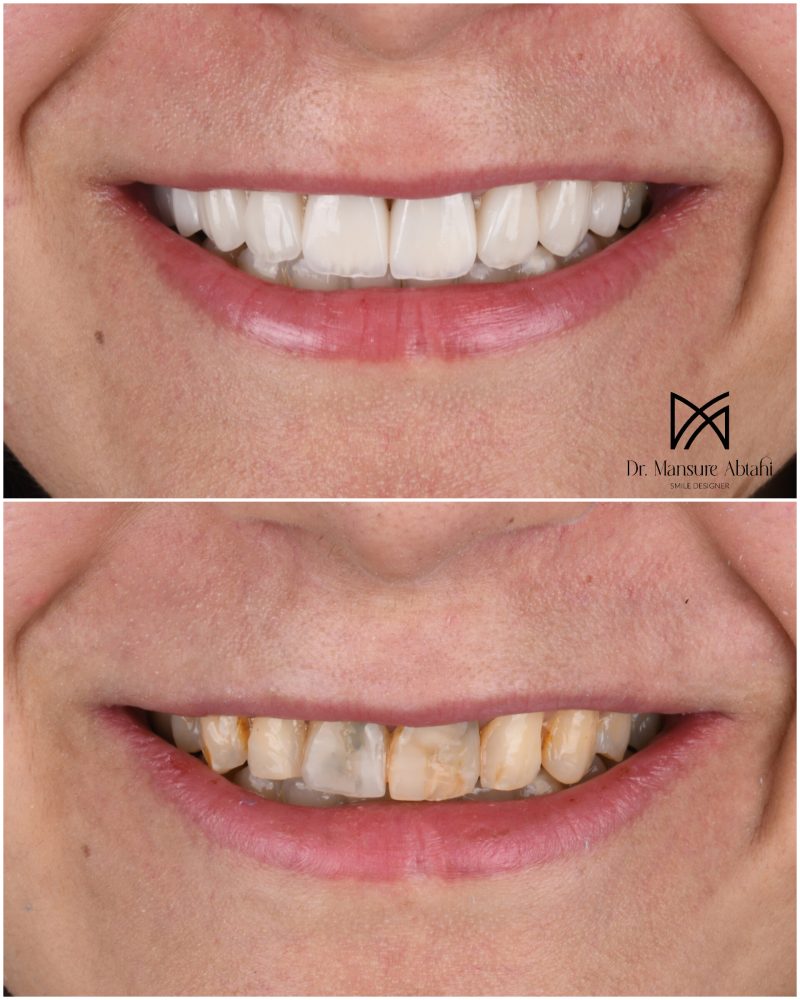 نمونه درمان لمینیت سرامیکی در اصفهان دکتر منصوره سادات ابطحی