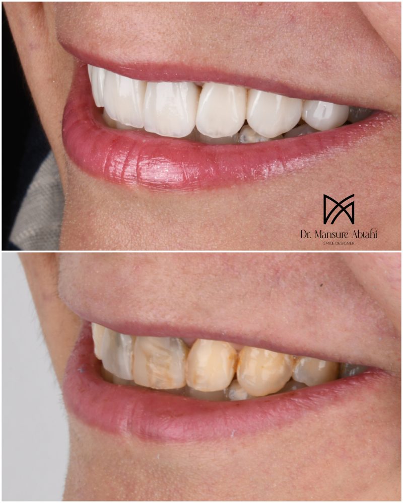 نمونه درمان لمینیت سرامیکی در اصفهان دکتر منصوره سادات ابطحی