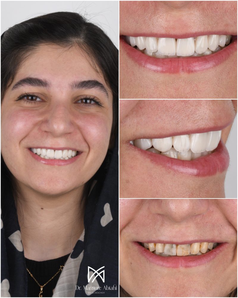 نمونه درمان لمینیت سرامیکی در اصفهان دکتر منصوره سادات ابطحی