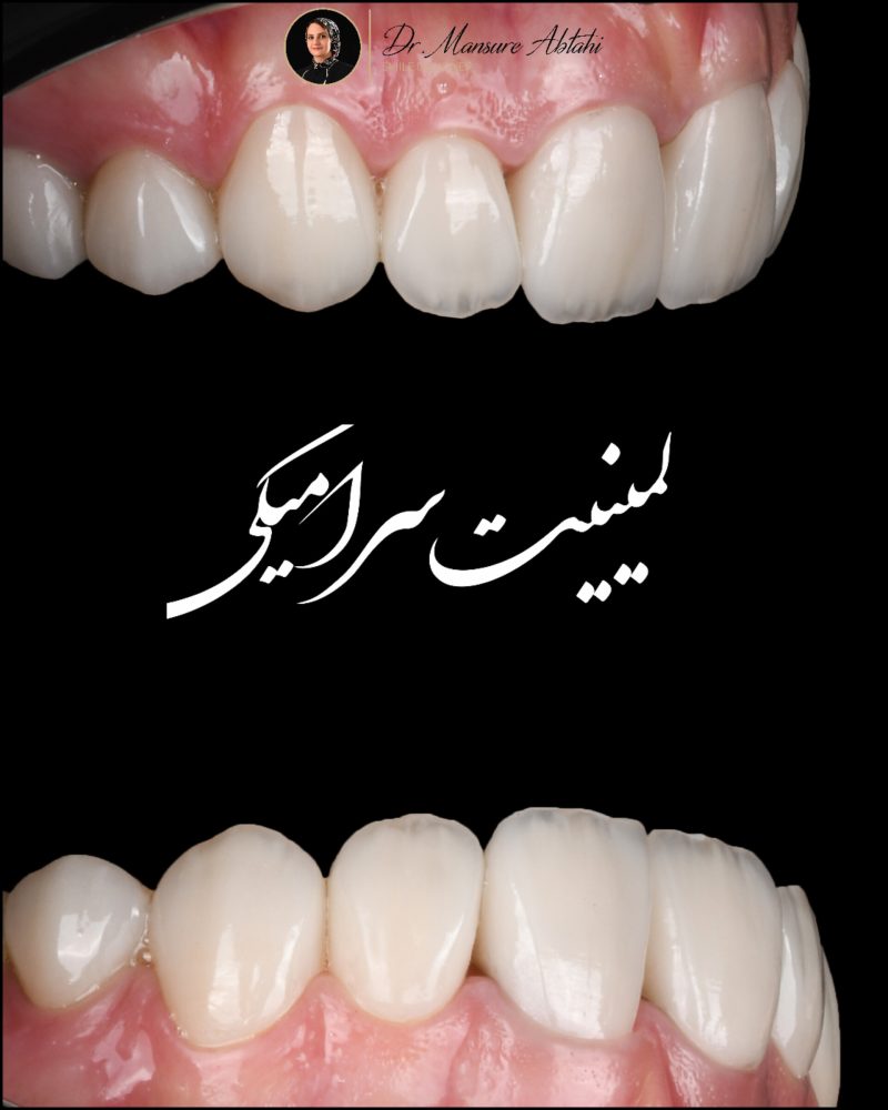 نمونه درمان لمینیت سرامیکی در اصفهان دکتر منصوره سادات ابطحی